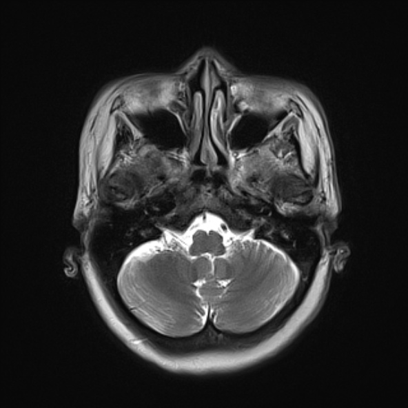 File:Clival meningioma (Radiopaedia 53278-59248 Axial T2 4).jpg