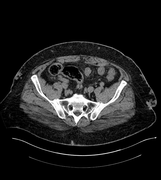 Closed-loop small bowel obstruction-internal hernia (Radiopaedia 78439-91096 Axial non-contrast 121).jpg