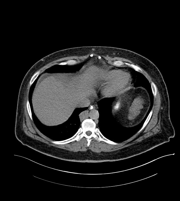 Closed-loop small bowel obstruction-internal hernia (Radiopaedia 78439-91096 Axial non-contrast 19).jpg