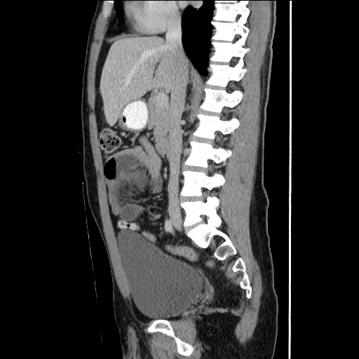 File:Closed-loop small bowel obstruction (Radiopaedia 73713-84509 B 77).jpg