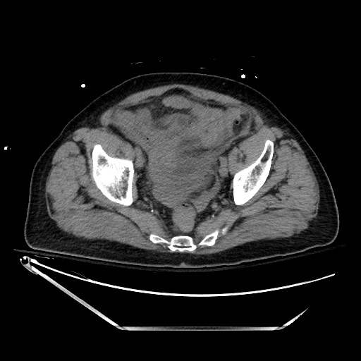 File:Closed loop obstruction due to adhesive band, resulting in small bowel ischemia and resection (Radiopaedia 83835-99023 Axial non-contrast 132).jpg