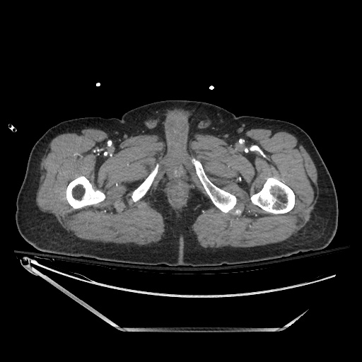 File:Closed loop obstruction due to adhesive band, resulting in small bowel ischemia and resection (Radiopaedia 83835-99023 B 170).jpg