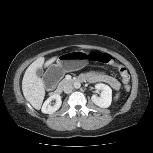 File:Closed loop small bowel obstruction (Radiopaedia 65403-74451 A 33).jpg