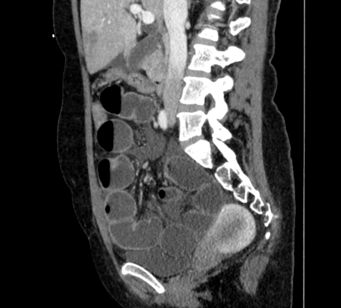 Closed loop small bowel obstruction (Radiopaedia 71211-81508 C 61).jpg