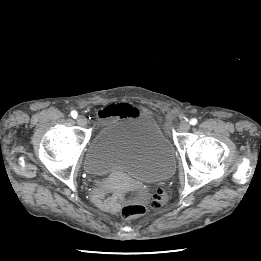 Closed loop small bowel obstruction - adhesions and infarct (Radiopaedia 85125-100678 A 189).jpg