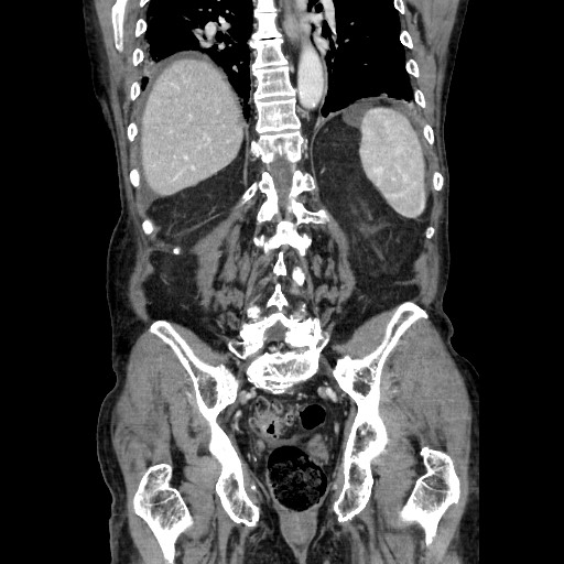 File:Closed loop small bowel obstruction - adhesive disease and hemorrhagic ischemia (Radiopaedia 86831-102990 B 95).jpg