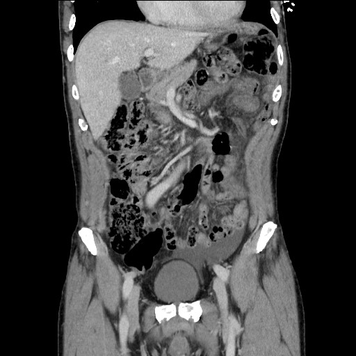 Closed loop small bowel obstruction - omental adhesion causing "internal hernia" (Radiopaedia 85129-100682 B 49).jpg