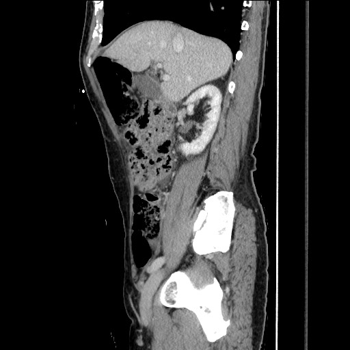 Closed loop small bowel obstruction - omental adhesion causing "internal hernia" (Radiopaedia 85129-100682 C 67).jpg