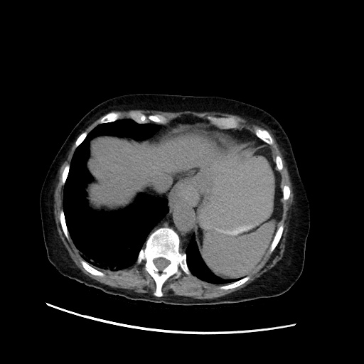 File:Closed loop small bowel obstruction due to adhesive band, with intramural hemorrhage and ischemia (Radiopaedia 83831-99017 Axial non-contrast 31).jpg