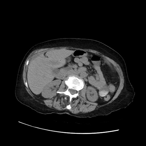 Closed loop small bowel obstruction due to adhesive band, with intramural hemorrhage and ischemia (Radiopaedia 83831-99017 Axial non-contrast 69).jpg