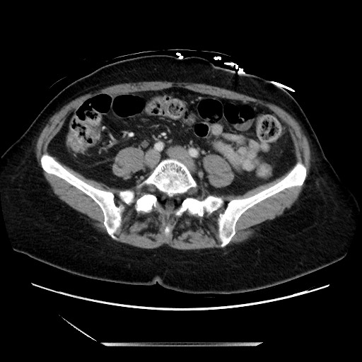 Closed loop small bowel obstruction due to adhesive bands - early and late images (Radiopaedia 83830-99014 A 99).jpg
