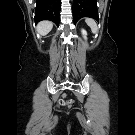 File:Closed loop small bowel obstruction due to adhesive bands - early and late images (Radiopaedia 83830-99015 B 100).jpg