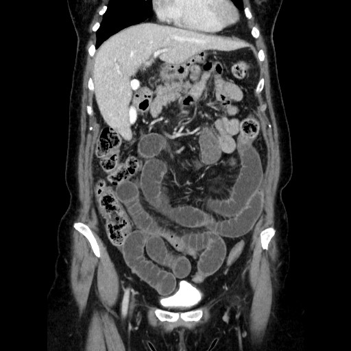 Closed loop small bowel obstruction due to adhesive bands - early and late images (Radiopaedia 83830-99015 B 44).jpg