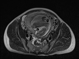 Closed loop small bowel obstruction in pregnancy (MRI) (Radiopaedia 87637-104031 D 24).jpg
