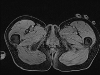 Closed loop small bowel obstruction in pregnancy (MRI) (Radiopaedia 87637-104031 G 41).jpg