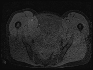 Closed loop small bowel obstruction in pregnancy (MRI) (Radiopaedia 87637-104031 G 72).jpg