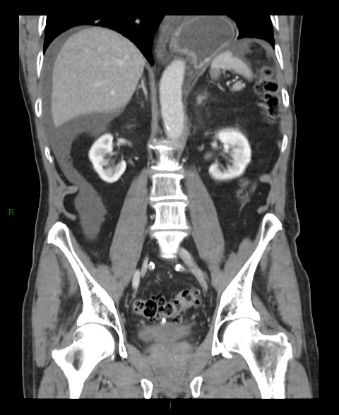 Closed loop small bowel obstruction with ischemia (Radiopaedia 84180-99456 B 27).jpg