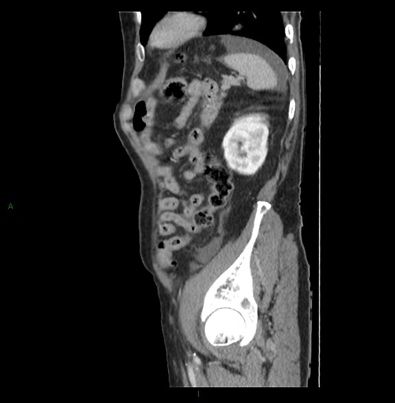 Closed loop small bowel obstruction with ischemia (Radiopaedia 84180-99456 C 73).jpg