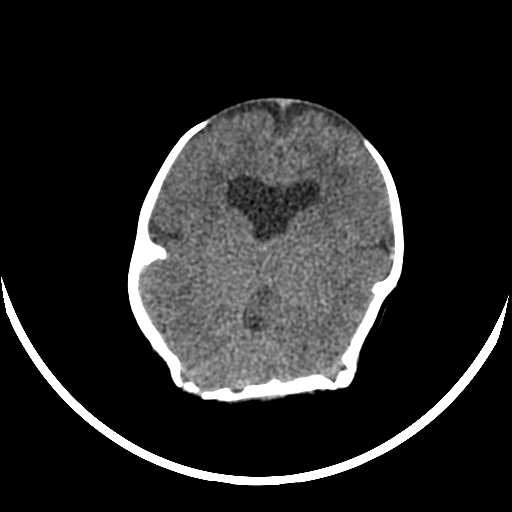 File:Cloverleaf shaped skull in the absence of craniosynostosis (Radiopaedia 21296-21216 Axial non-contrast 9).jpg