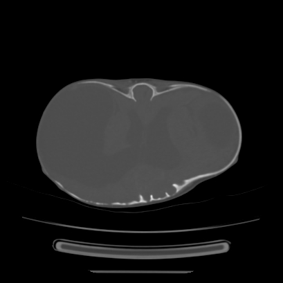 Cloverleaf skull (Radiopaedia 91901-109710 Axial bone window 97).jpg