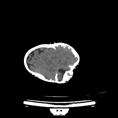 Cloverleaf skull (Radiopaedia 91901-109710 Axial non-contrast 127).jpg
