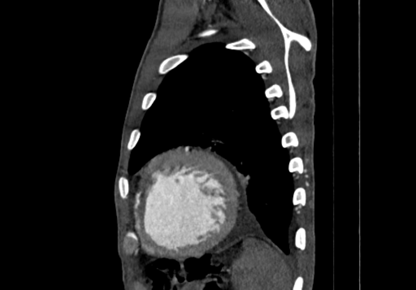 Coarctation of aorta with aortic valve stenosis (Radiopaedia 70463-80574 B 199).jpg