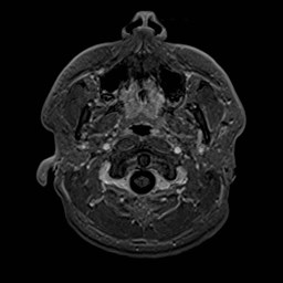 File:Cochlear incomplete partition type III associated with hypothalamic hamartoma (Radiopaedia 88756-105498 Axial T1 C+ 21).jpg