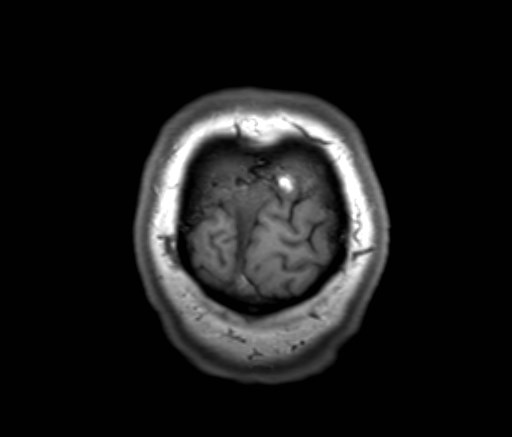 Cochlear incomplete partition type III associated with hypothalamic hamartoma (Radiopaedia 88756-105498 Coronal T1 6).jpg
