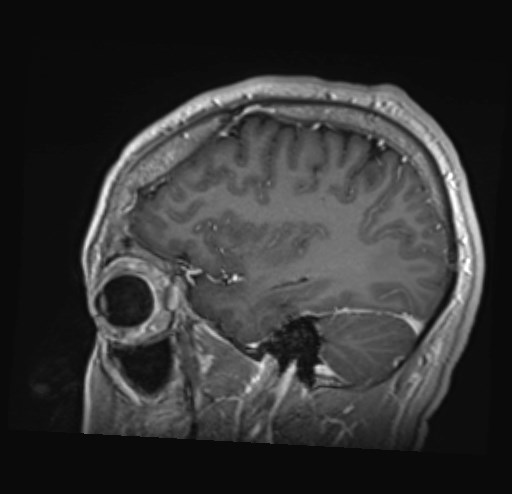Cochlear incomplete partition type III associated with hypothalamic hamartoma (Radiopaedia 88756-105498 Sagittal T1 C+ 15).jpg