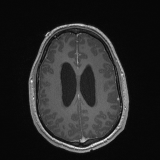 File:Colloid cyst (Radiopaedia 44510-48181 Axial T1 C+ 129).png