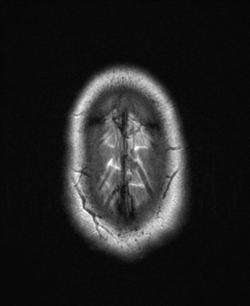 File:Colloid cyst (Radiopaedia 44510-48181 Axial T2 27).png