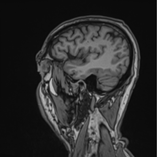 File:Colloid cyst of the third ventricle (Radiopaedia 86571-102662 Sagittal T1 17).png