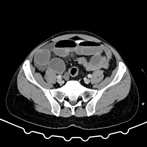 File:Colocolic intussusception due to large lipoma (Radiopaedia 68773-78482 A 143).jpg