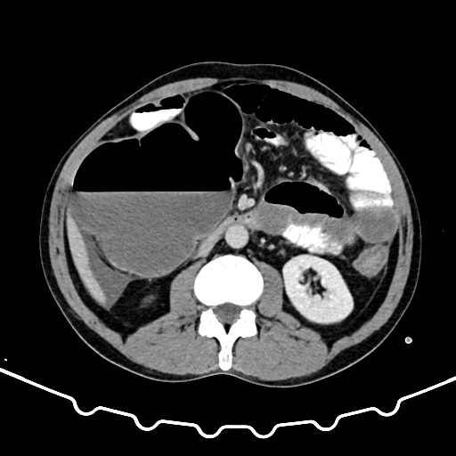 Colocolic intussusception due to large lipoma (Radiopaedia 68773-78482 A 85).jpg