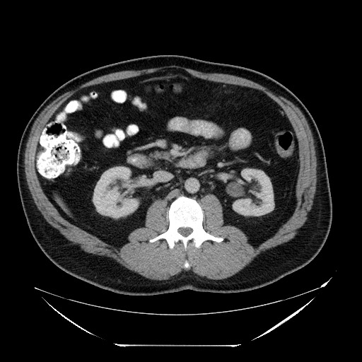 File:Colocolic intussusception due to lipoma (Radiopaedia 73712-84508 Axial 28).jpg