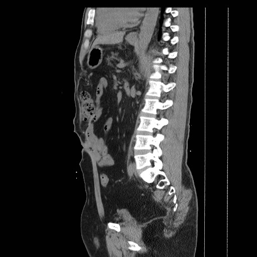 File:Colocutaneous fistula in Crohn's disease (Radiopaedia 29586-30093 C 31).jpg
