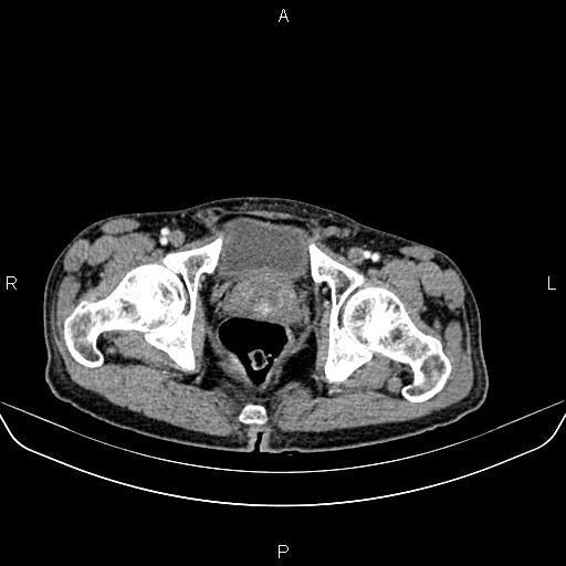 Colon adenocarcinoma - hepatic flexure (Radiopaedia 85635-101395 A 95).jpg