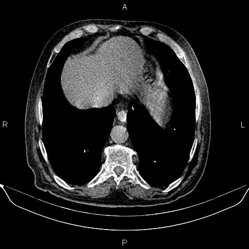 File:Colon cancer (Radiopaedia 90215-107432 Axial non-contrast 10).jpg