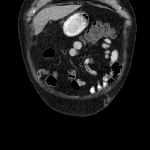 File:Colon cancer with duodenal invasion (Radiopaedia 16278-15958 B 8).jpg