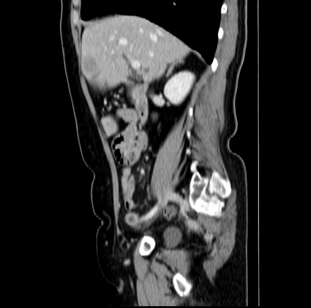 Colon carcinoma with hepatic metastases (Radiopaedia 29477-29961 C 20).jpg