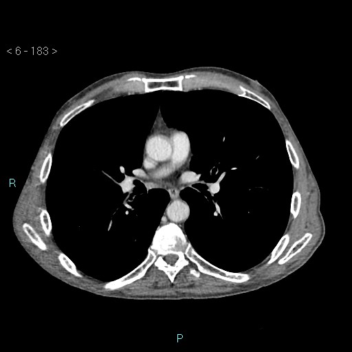 File:Colonic cancer (ultrasound and TC imaging) (Radiopaedia 50346-55713 B 183).jpg