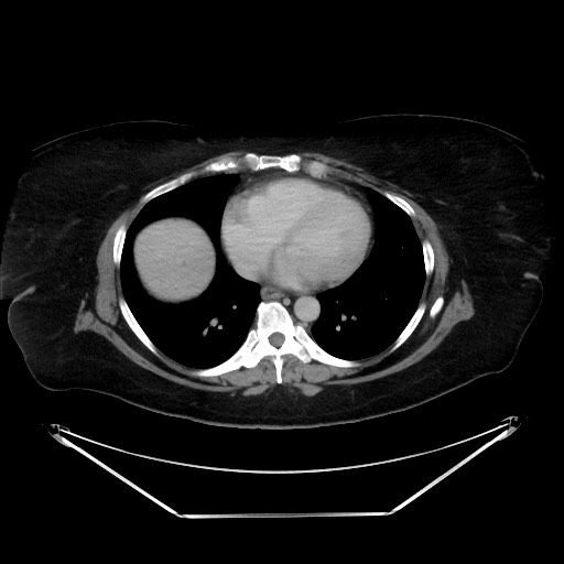File:Colonic intussusception due to adenocarcinoma (Radiopaedia 86828-102987 A 11).jpg