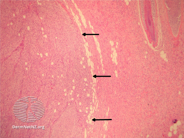 File:Figure 2 (DermNet NZ pathology-e-fibrosarcoma-figure-2).jpg