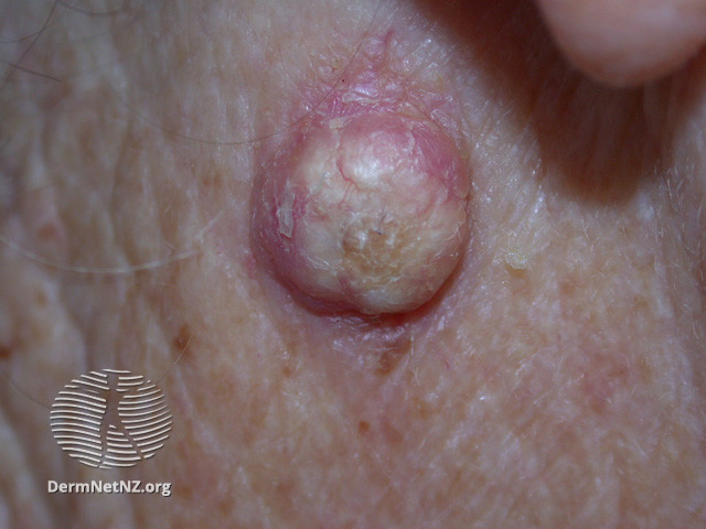 File:Keratoacanthoma (DermNet NZ lesions-ka2).jpg