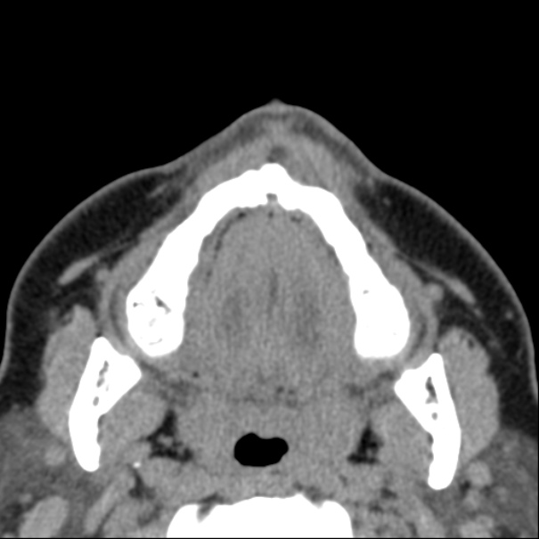 Nasolabial cyst (Radiopaedia 33987-35205 Axial non-contrast 2).jpg