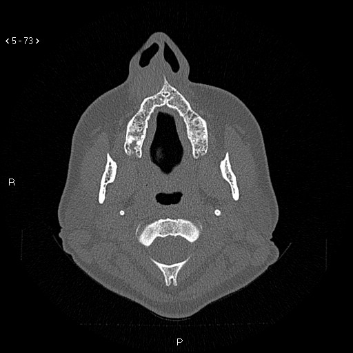 Nasolabial cyst (Radiopaedia 75125-86194 Axial bone window 34).jpg