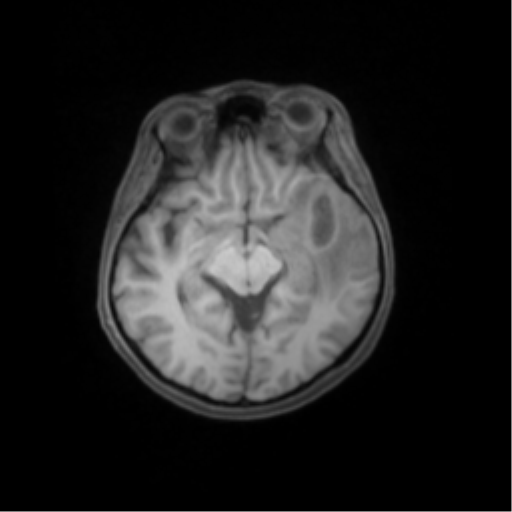 File:Nasopharyngeal carcinoma with cerebral abscess (Radiopaedia 43018-46274 Axial T1 fat sat 24).png