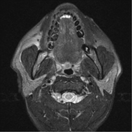 File:Nasopharyngeal carcinoma with pterygopalatine fossa involvement (Radiopaedia 33102-34134 Axial T2 9).png