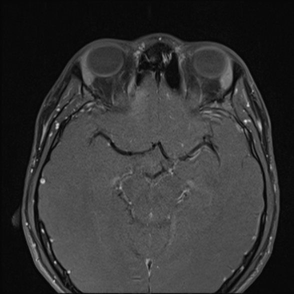 Nasopharyngeal carcinoma with skull base invasion (Radiopaedia 53415-59485 Axial T1 C+ fat sat 13).jpg