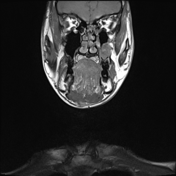 File:Nasopharyngeal carcinoma with skull base invasion (Radiopaedia 53415-59485 Coronal T1 31).jpg